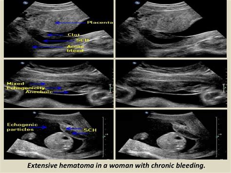 Presentation1 Pptx Ultrasound Examination Of The 1st Trimester Pregn…