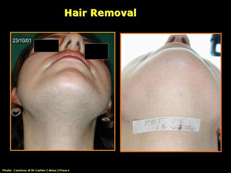 IPL Hair Removal Before & After - Estetika Studio Ltd