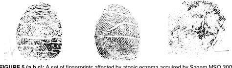 PDF Generation Of Skin Diseases Into Synthetic Fingerprints