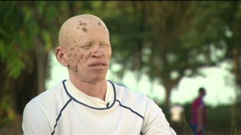 Malawi S Albinos At Risk Of Total Extinction U N Warns