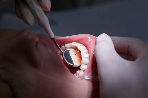 Alimentos Que Fazem Mal Aos Dentes