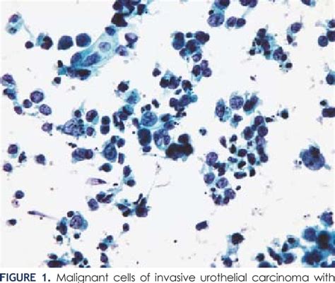 Figure 2 from Urine and bladder washing cytology for detection of urothelial carcinoma: standard ...