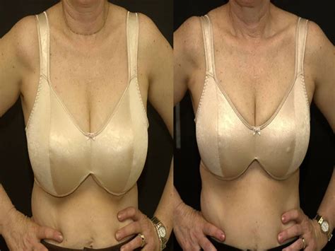 Breast Reduction With Liposuction Only Sadove Cosmetic Surgery