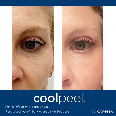 Cool Peel Co2 Laser Resurfacing — The Skin Spot Laser Club Cape Coral S Top Rated Med Spa