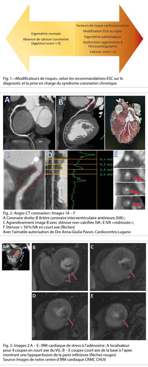 L Imagerie Cardiaque Non Invasive Face Au Syndrome Coronarien