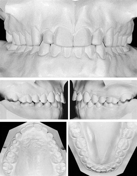 Treatment Of A Class Iii Malocclusion With Maxillary Constriction And