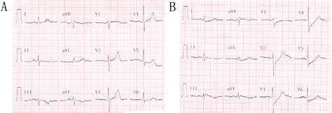 Figure 1 from De Winter ECG Pattern Can Be A Temporary ECG Phenomenon Related To Severe Stenosis ...