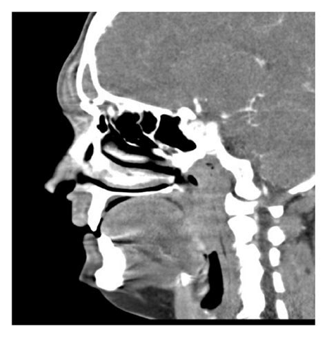 Sagittal Ct Image Mucocele Overlying Frontal Sinus Download