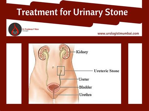 Urinary Stone Is One Of The Most Common Urological Disorder At Urology