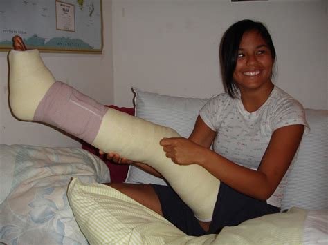 Long Leg Cast Flickr