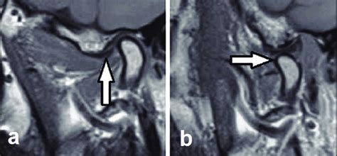 Tmj Mri