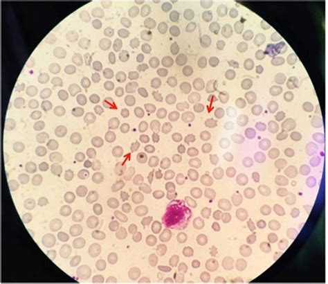 peripheral blood smear showing acanthocytes (red arrows). | Download ...