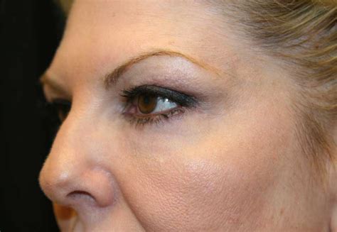 The Perfect Lower Eyelid-No Wrinkles, No Hollow Circles | Dr. Haworth