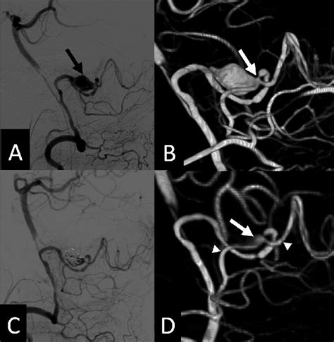 A Preoperative Left Vertebral Artery Angiography Lateral View Shows