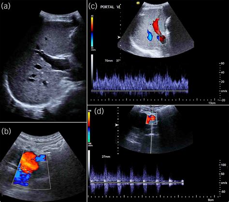 A Rare Case Of An Iatrogenic Superior Mesenteric Arteriovenous Fistula