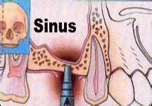 What is Sinus Elevation with the Osteotome technique? - Calgary Dental Implants & Canada ...