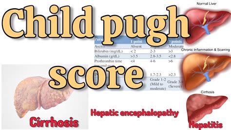 Child Pugh Score Cirrhosis Pharmd Nivedita Hepaticimpairment