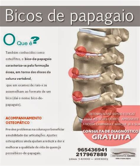 Osteopatia Sa De Bicos De Papagaio O Que