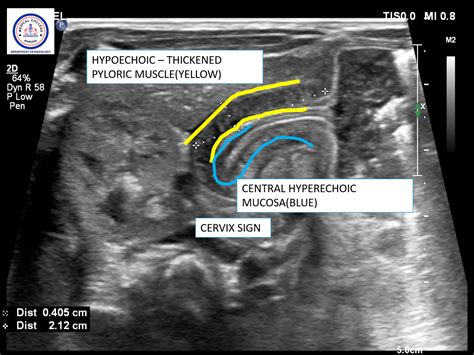 Congenital Hypertrophic Pyloric Stenosis