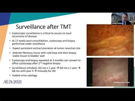 Trimodality Therapy For Management Of Muscle Invasive Bladder Cancer