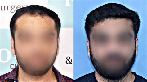 Best Hair Transplant Result 2021 Nw Grade Ii A 2695 Grafts Regrow Clinic Haridwar