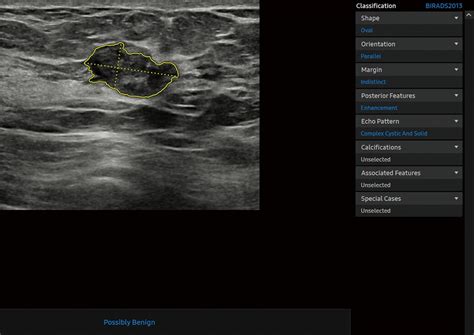 Deep LearningBased Computer Aided Diagnosis For Breast Lesion