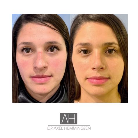 Rinoplastia Precio Caba Dr Axel Hemmingsen