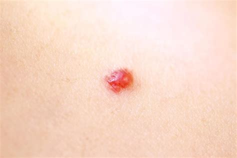 The Mystery of Those Lumps and Bumps on Skin, Explained | Reader's Digest