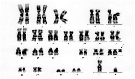 Figure 1 From Noninvasive Prenatal Testing Aids Identification Of