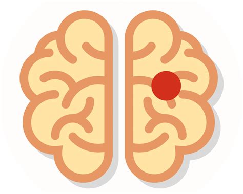 What causes stroke?