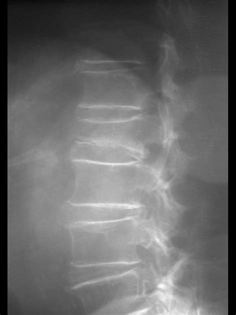 Radiografia De Columna Lumbar