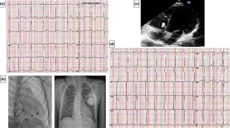 Case 2 Panel A 12‐lead Ecg Showing The Intrinsic Junctional Rhythm Download Scientific