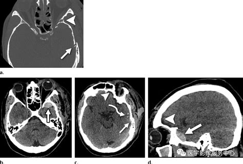 医影精品 创伤性颅脑损伤的影像学表现及并发症