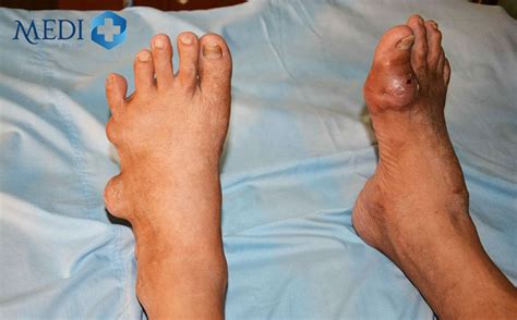 Cách nhận biết và chữa trị hình ảnh bệnh gout hiệu quả nhất