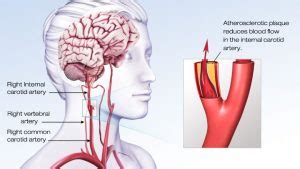 Ischemic Stroke Symptoms and Treatment | Pacific Stroke & Aneurysm Center