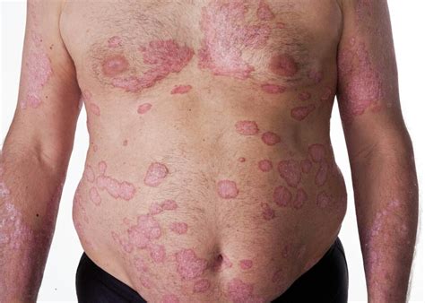 Psoriasis Is A Long Lasting Autoimmune Disease Cha