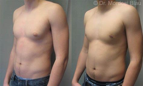 Unilateral Gynecomastia Before And After Photos ⋆ Gynecomastia Usa