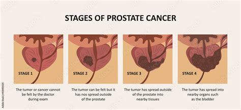 Stages Of Prostate Cancer The Tumor Grows And Penetrates Into Organs