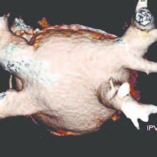 Volume Rendering Mdct Image Shows Most Frequent Type Of Mpv Drainage