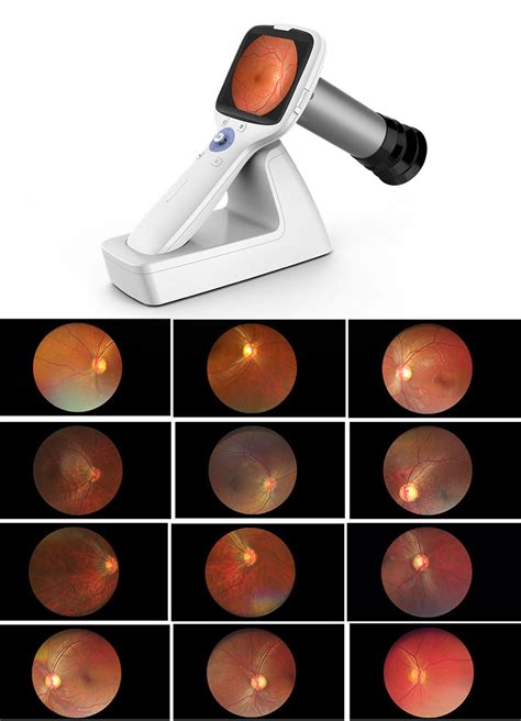 Non Mydriatic Fundus Camera Competitive Distributor Price