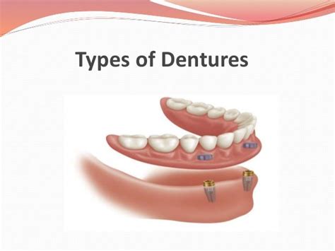 Types of Dentures