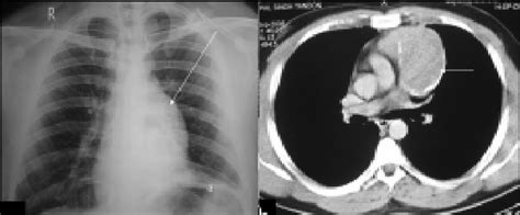 A Chest X Ray Pa View Showing A Posterior Mediastinal Mass The Right Download Scientific