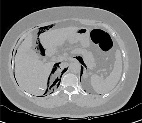 Retroperitoneal Colon Perforation After Endoscopic Polypectomy Successfully Treated By