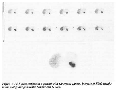 Cancer Biology Diagnosing Pancreatic Cancer Using A Pet Scan