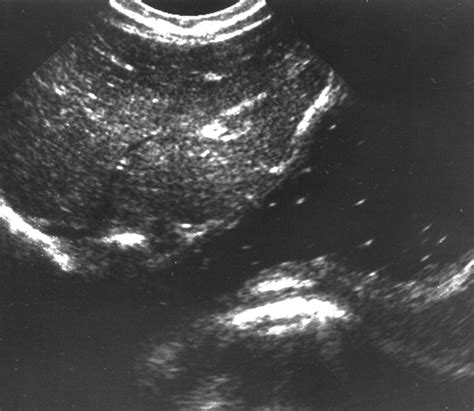 Gastroesophageal Junction Ultrasound