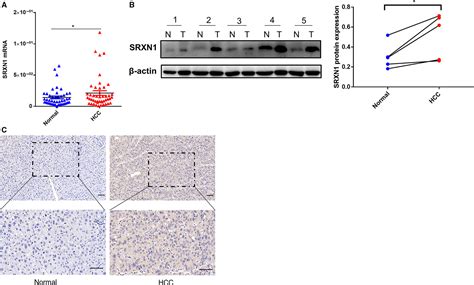 Sulfiredoxin1 Is A Promising Novel Prognostic Biomarker For