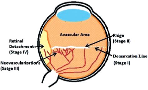 The Scheme Of The Right Eye Demonstrating Zones Of Retinopathy Of