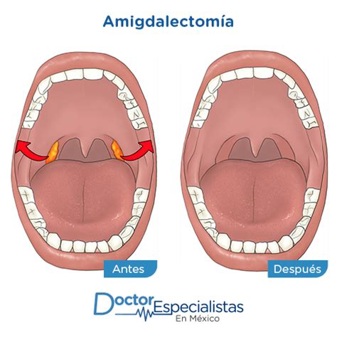 Especialistas En Amigdalectomia Doctor Especialistas