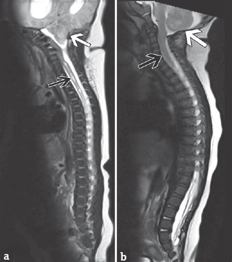 Giant Occipital Encephalocele With Chiari Malformation Type Journal