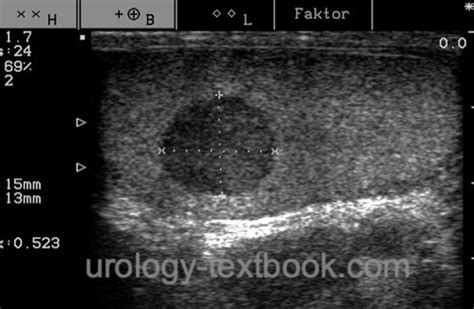 Leydig Cell Tumor Of The Testis Diagnosis And Treatment